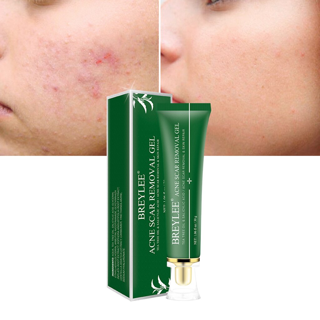  BREYLEE Scar Removal Gel Facial Anti Acne Pimple Removal Repair Sooth Essential Oil Whitening Anti-aging Oil Control Facial
